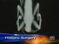 Parasitic Twin Separation (CBS News)