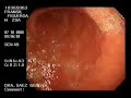 Endoscope Endoscope