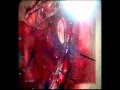 Meningioma Microsurgery, Tumor Cerebral (Thrace-Greece)