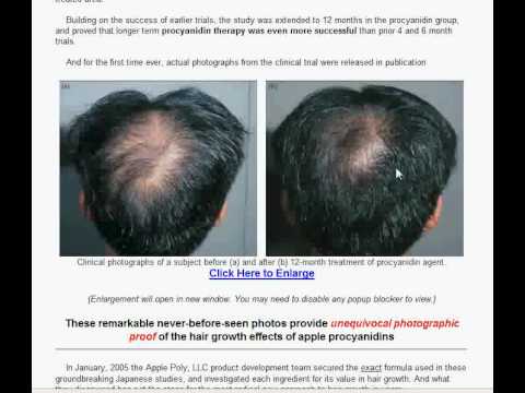 how to treat alopecia x