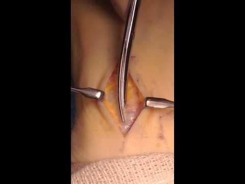 Anterior Tarsal Tunnel Release SFISM