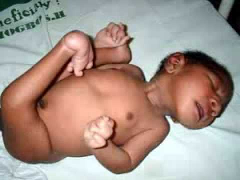 Edwards Syndrome