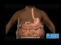 Manga Gastrica, Sleeve Gastrectomy, Argentina Manga Gastrica, Sleeve Gastrectomy, Argentina