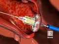 V�a transapical en el reemplazo de la v�lvula a�rtica