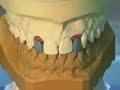 straumann dental implant Cemented single-tooth restoration 2 straumann dental implant Cemented single-tooth restoration 2