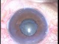 Phaco(OZIL) , small pupil Phaco(OZIL) , small pupil