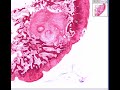 Histopathology Bone--Osteoarthritis, subchondral cyst