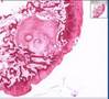 Osteoarthritis, subchondral cyst Osteoarthritis, subchondral cyst