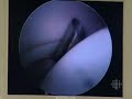 Hip Arthroscopy