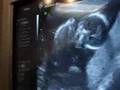 15 weeks ultrasound