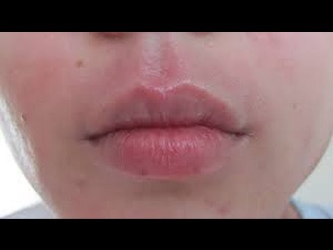 how to get rid of eczema on lips