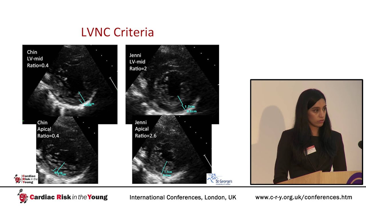 Left ventricular hypertrabeculation: Another phenotype of the athletic heart?