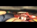DCRV Congenital heart Surgery - Pediatric Heart Surgery