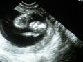 Ultrasound 12w2d 12 Weeks 2 Days