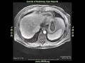 Calcific constrictive pericarditis demonstrated on 99mTc-MDP bone scintigraphy