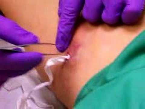 Abscess surgery#3