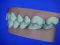 Invisalign