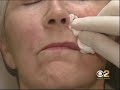 Evolence Collagen Injection in Los Angeles and Beverly Hills Evolence Collagen Injection in Los Angeles and Beverly Hills