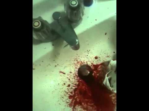 how to stop a huge nose bleed