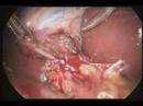 Laparascopia-Dr-Alon