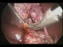 Laparascopia-Dr-Alon