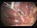 Laparascopia-Dr-Alon