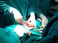nephrectomy