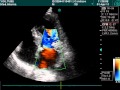 Mitral Valvulopathy In Echo Examination Mitral Valvulopathy In Echo Examination