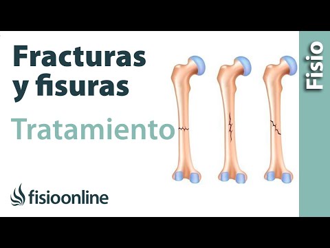 Fracturas menores y fisuras - Inmovilización relativa y tratamiento alternativo.