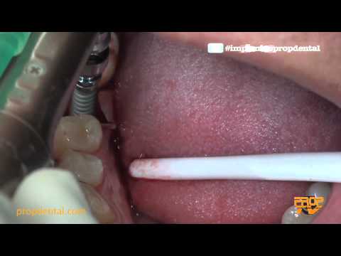 cirugía dental - Implantes dentales en barcelona, colocación de un implante dental sus fases y proceso de la cirugía de implantes de titanio. Cirugia de colocación de un impl...