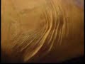 Adhesions and burn scars/ skin grafts