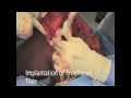 Dr. James Wittig: Radical Resection of Distal Femur [Part 4]