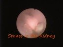 Nefroscopy, stone removal and laser