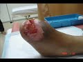Diabetic Gangrene Case 002 LJH001 Diabetic Gangrene Case 002 LJH001