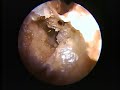 Anterior Ethmoid Dissection Anterior Ethmoid Dissection