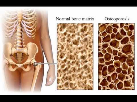 how to control osteoporosis