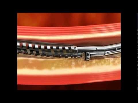 how to repair arteries