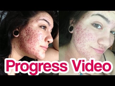 Before & After Accutane SEVERE Acne Progress Video [Shitty Quality]