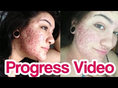 how to use x out acne