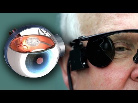 blindness - First Bionic Arms- Now Bionic Eyes! Last week the FDA gave approval to the Argus II, a bionic eye that could potentially cure blindness in 15000 people in t...