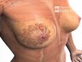animaciones cancer 1 animaciones cancer 1