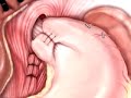 PreOp® Patient Education Hernia Hiatal Laparoscopic Surgery3  GERD Hernia