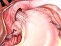 PreOp-Patient-Educat