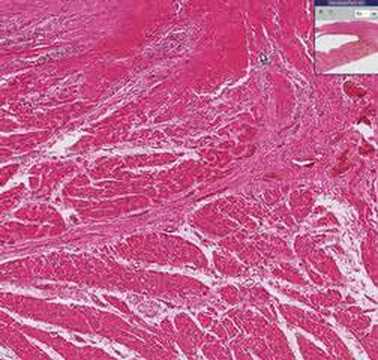 Histopathology Heart--Subacute ...