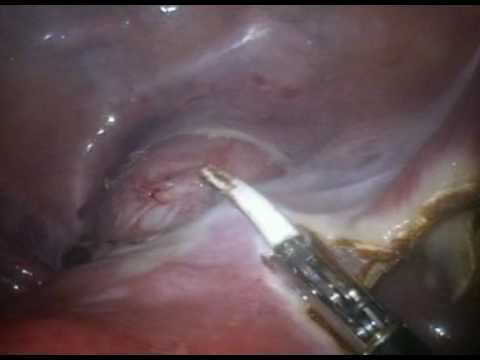 LESS Management Of Uterus And Gallbladder Removal