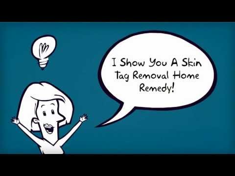 how to remove skin tags nhs