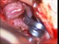 Basilary artery bifurcation(top)+posterior cerebral artery aneurysms-dr suresh dugani/HUBLI/INDIA