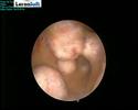 hysteroscopy-medicap-videoimageaudio-capture-system-for-m.html