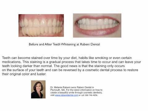 how to slowly whiten teeth