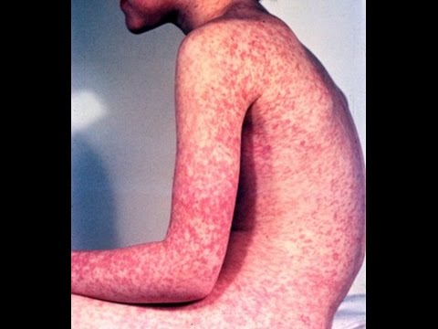 how to cure rubella